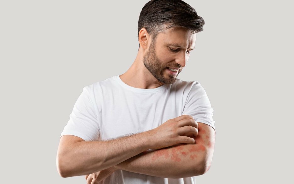 Das Foto zeigt einen Mann im T-Shirt, der sein Gesicht verzieht, während er auf einen juckenden, roten Hautausschlag am linken Arm schaut und sich dort mit der rechten Hand kratzt. 